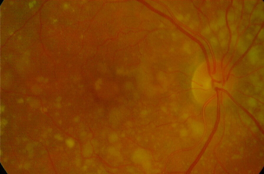 Macular Degeneration