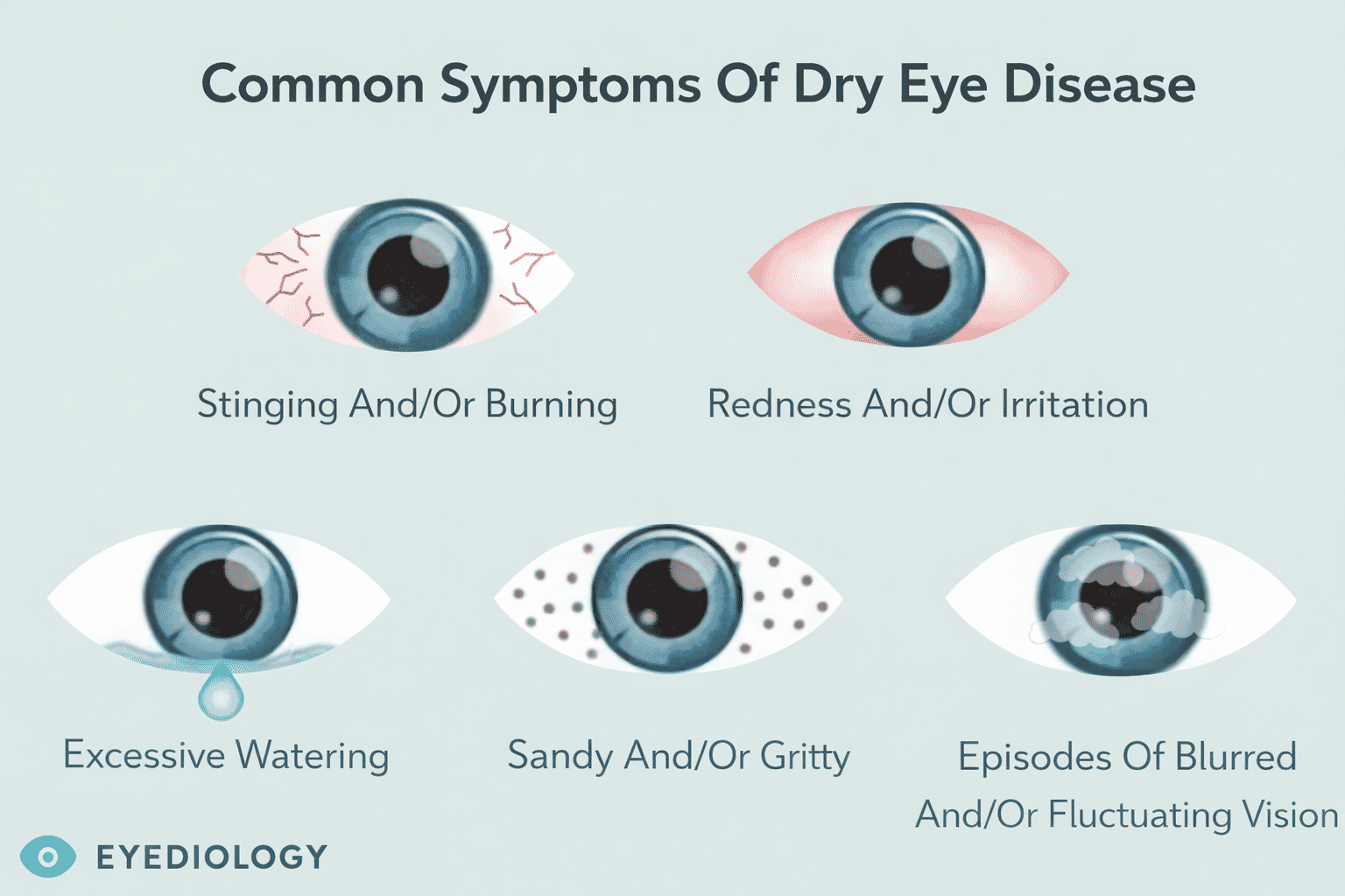 Infographic illustrating common symptoms of dry eye disease including stinging, burning, redness, watering, gritty sensation, and blurred or fluctuating vision.