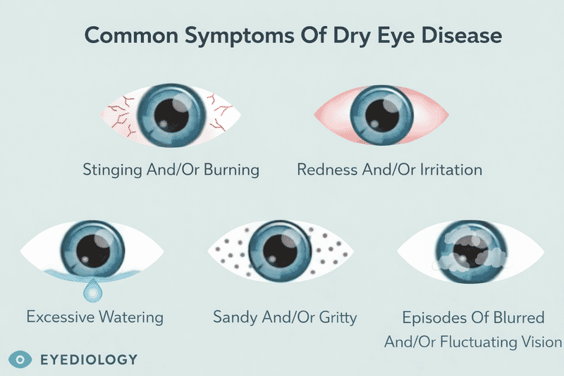 Infographic illustrating common symptoms of dry eye disease including stinging, burning, redness, watering, gritty sensation, and blurred or fluctuating vision.